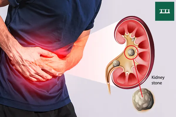 kidney-stones-early-warning-signs-and-symptoms-to-watch-for